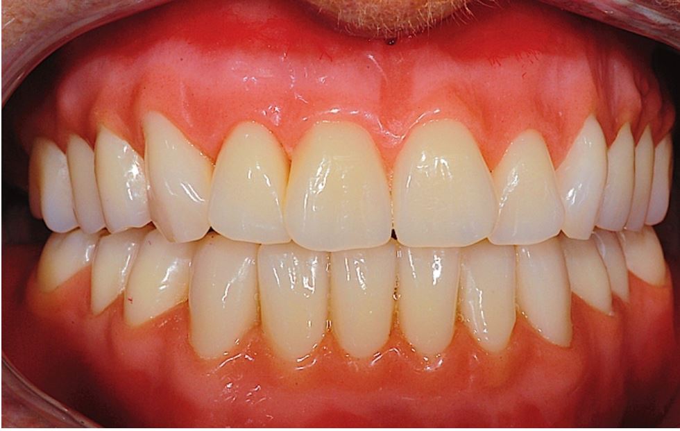 Vollprothese Online Video